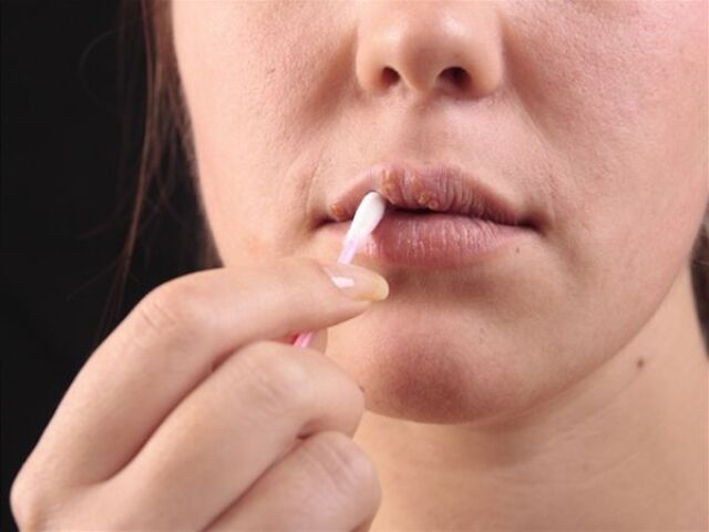 herpes, pery