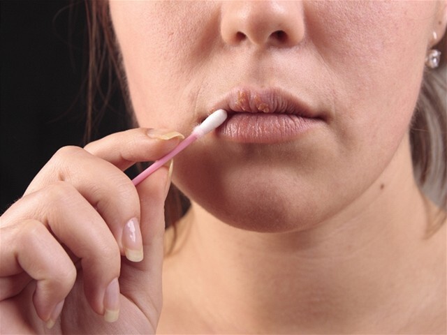 ústa, herpes, vírus,