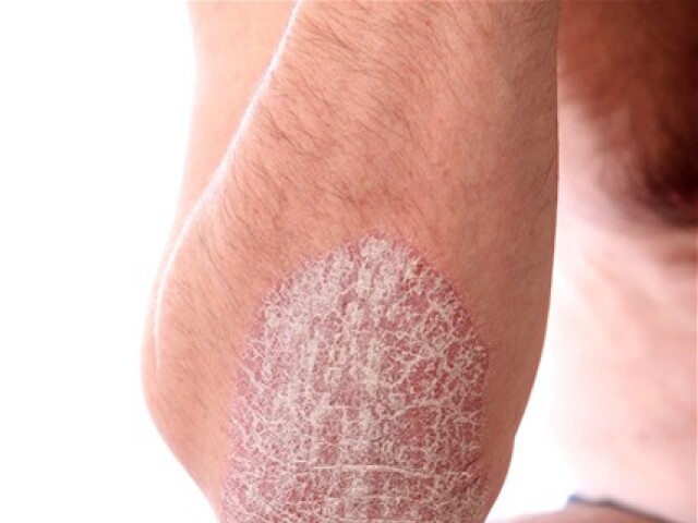 psoriáza - kožné problémy - vyrážky - suché lakte