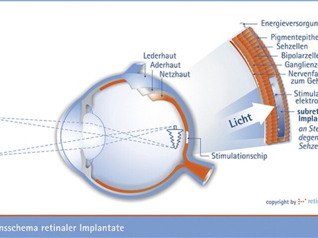 implantát v oku