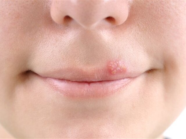 opar - herpes - pery s infekciou