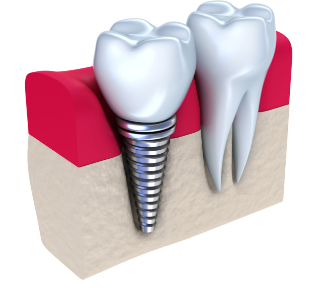 zub, zubný implantát