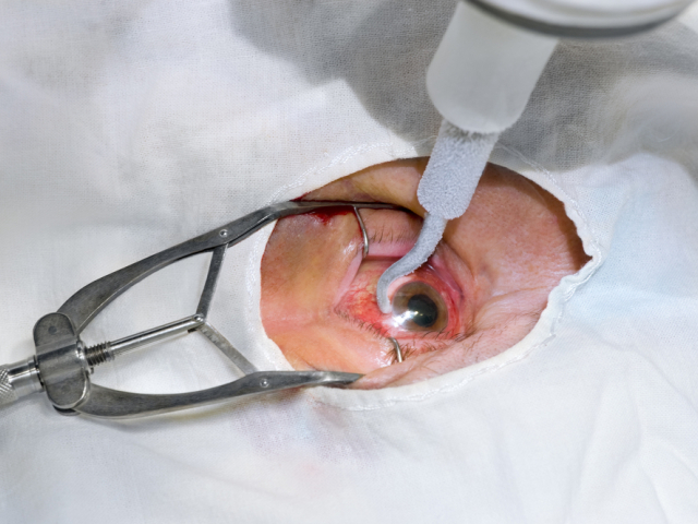 oko, šošovka, operácia očí, chirurgia, implantát, zákal, rohovka