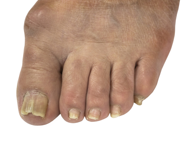 nechty, diabetická noha, medicinálna pedikúra