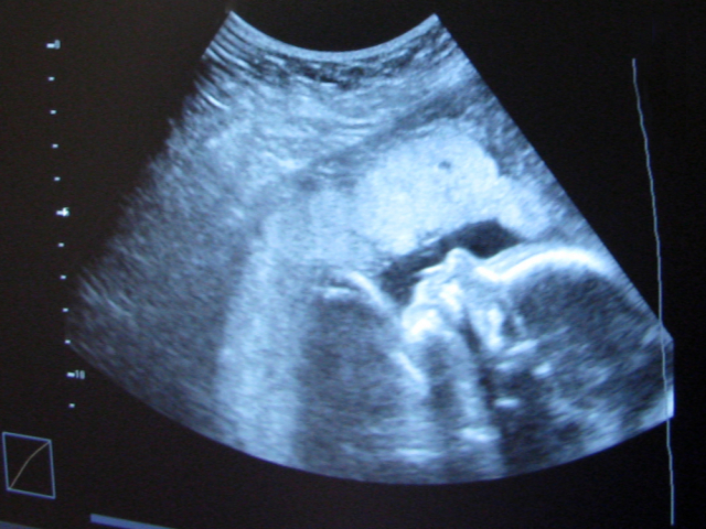 ultrazvuk, tehotenstvo, embryo, plod, materstvo