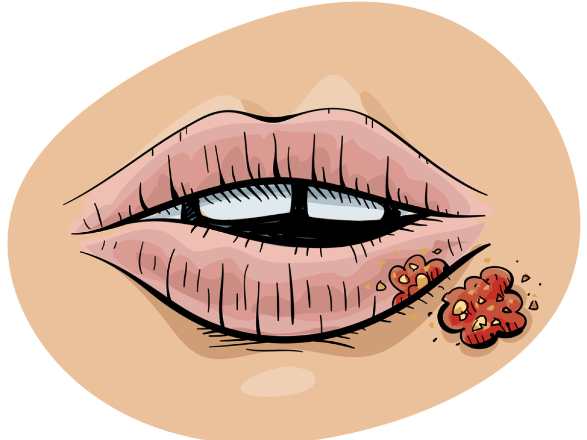 opar, herpes