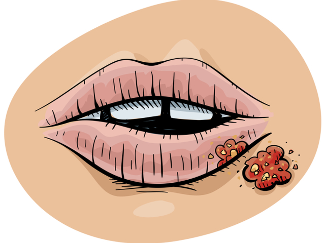 opar, herpes