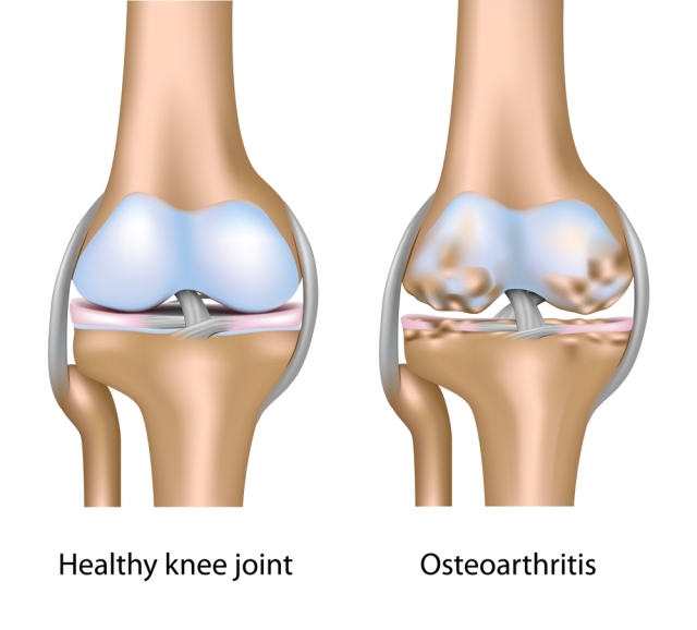 kĺb, koleno, osteoartróza, artróza