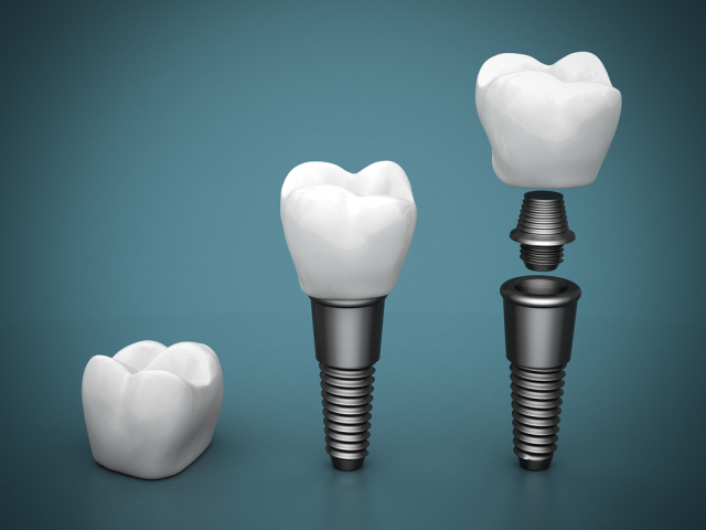 zub, implantát