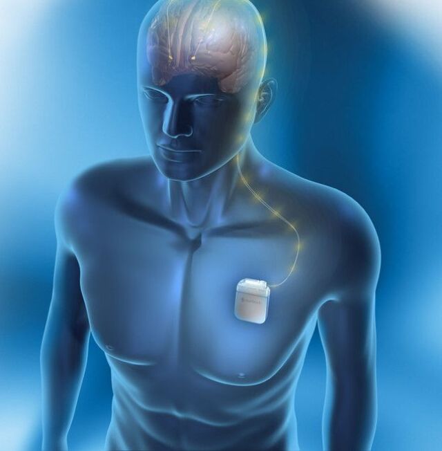 epilepsia, mozog, stimulácia