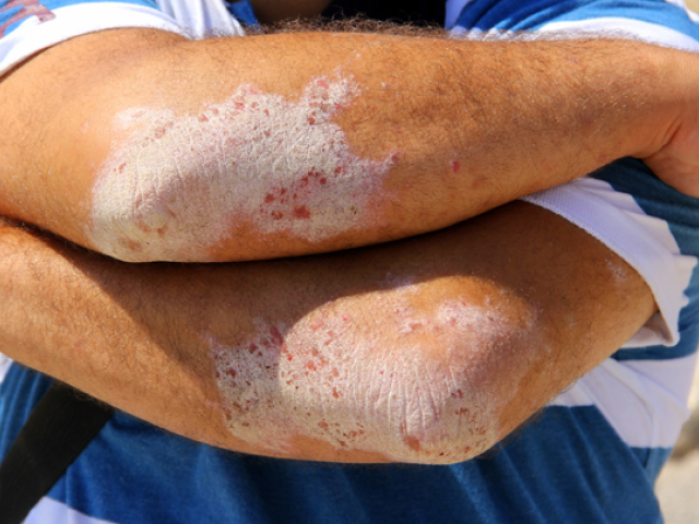 psoriáza