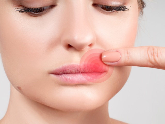 Herpes, žena, infekcia,