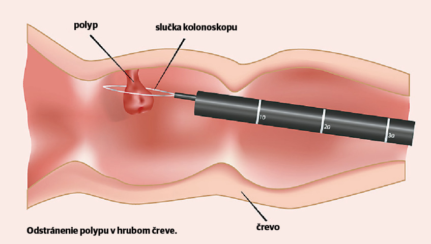 polyp, črevo, kolonoskopia