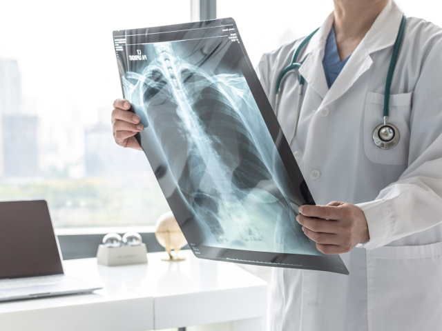 doktor, röntgenová snímka, pľúca
