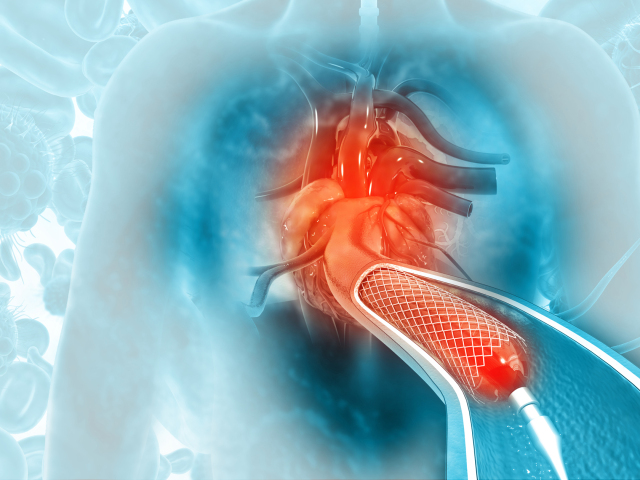 srdce, operácia, stent