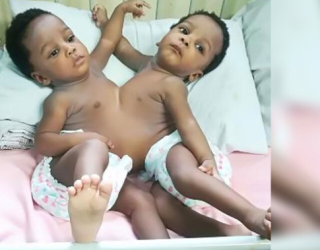 conjoined-twins-separated