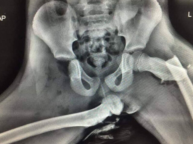 Zlomenina - Rontgen