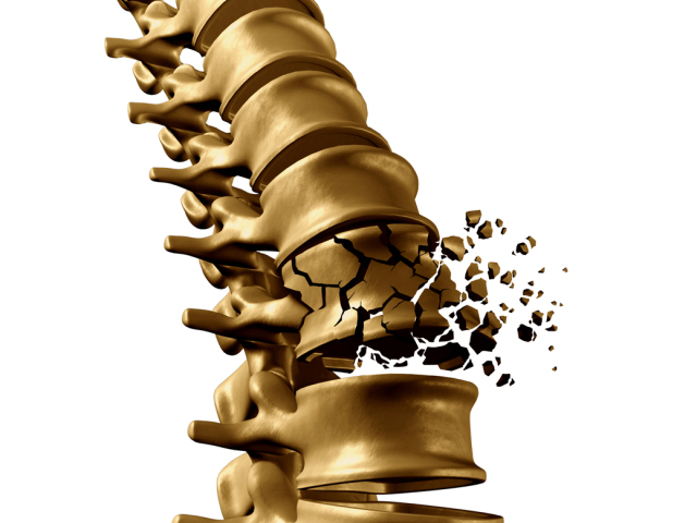 chrbtica, stavec, lámanie, osteoporóza