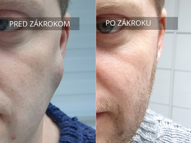 lipóm, hrčka, nádor na koži, chirurgia, tuková hrčka