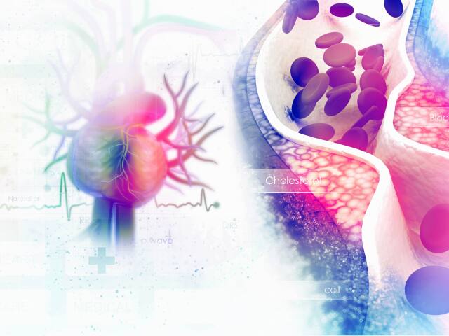 srdce, cholesterol, infarkt, problémy, ochorenia, upchávanie ciev