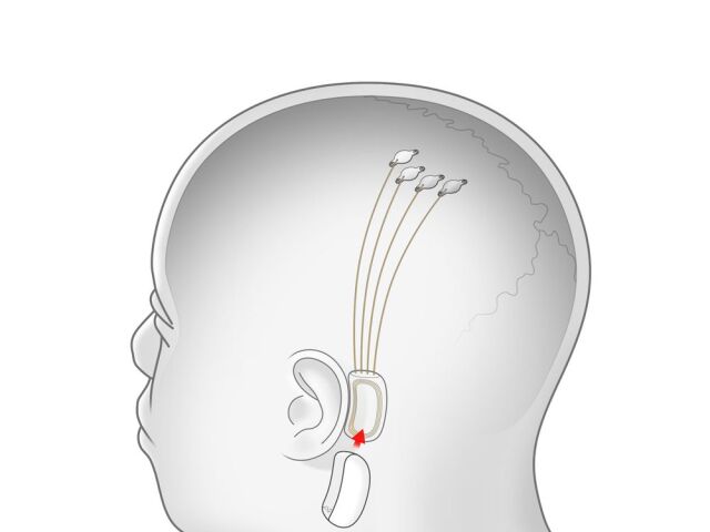 Neuralink, mikročip, implantát