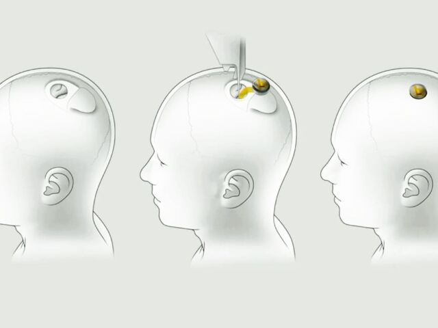 Neuralink, mikročip, implantát