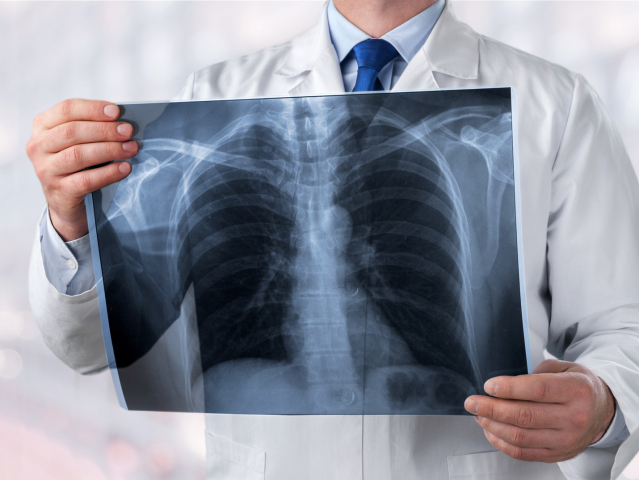 doktor, snímka, pľúca, röntgen, RTG