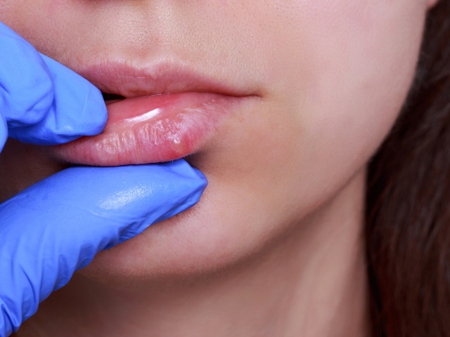 herpes, pera, lekár, herpes simplex, zdravie,