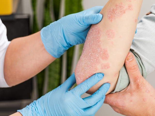 dobré zdravie, psoriaza,