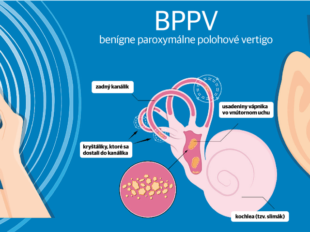 ucho, rovnováha, vertigo, vestibulárny aparát, BPPV