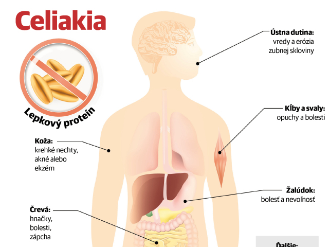 celiakia, lepok, príznaky celiakie