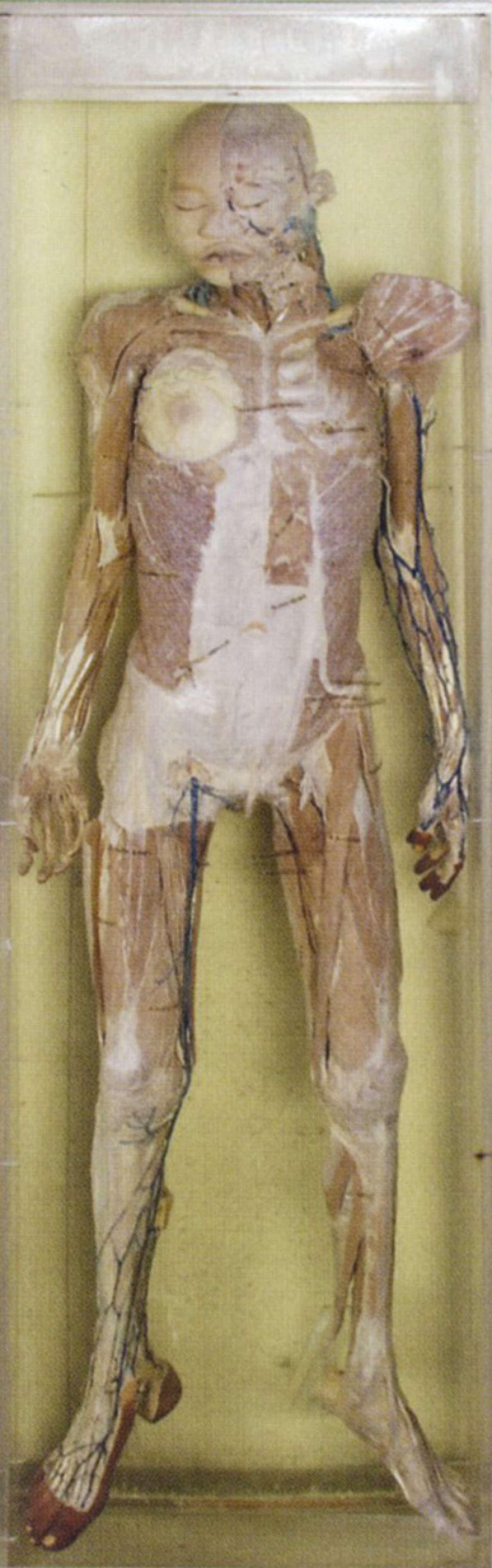 Anatomické múzeum, mŕtvola, exponát, Bangkok