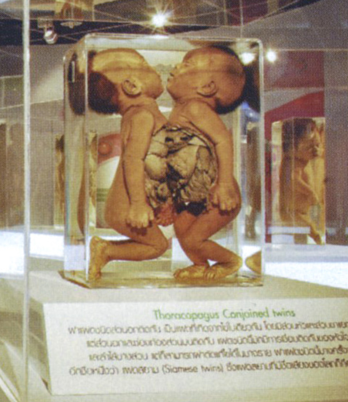 siamské dvojčatá, Anatomické múzeum, Bangkok
