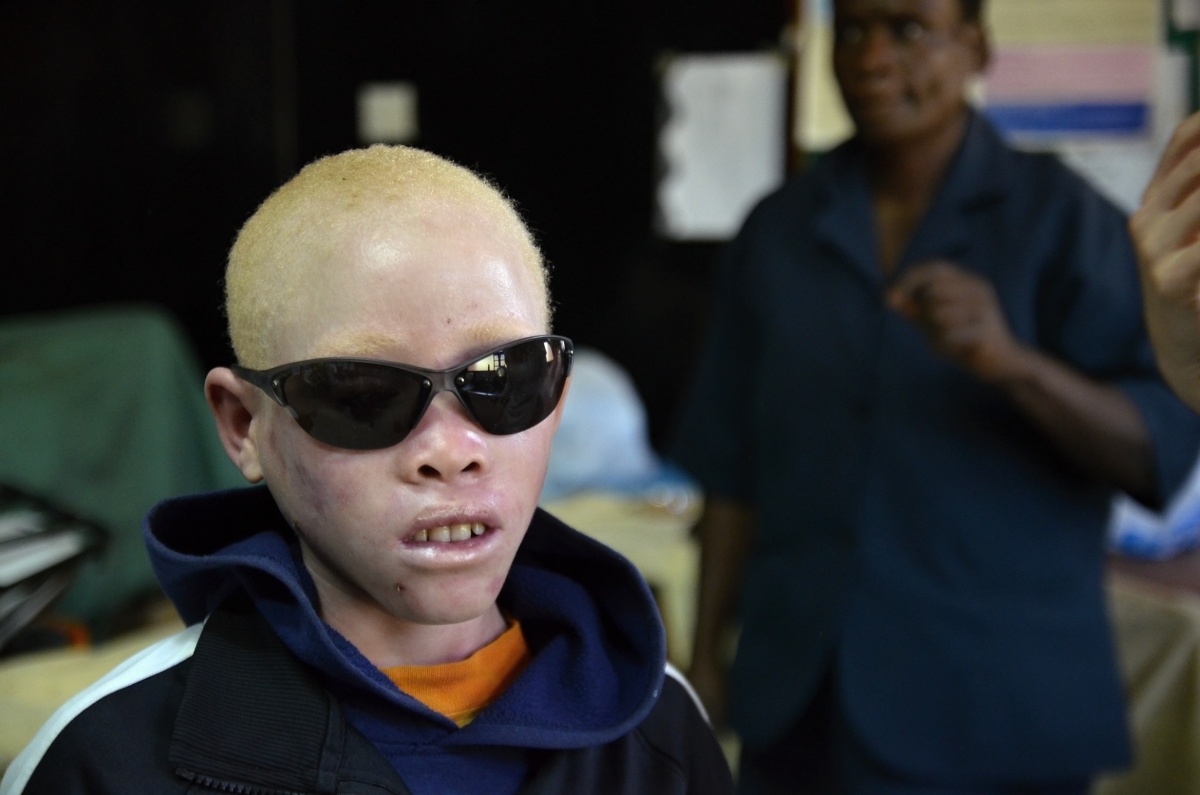 albín, albíni, albinizmus, Malawi