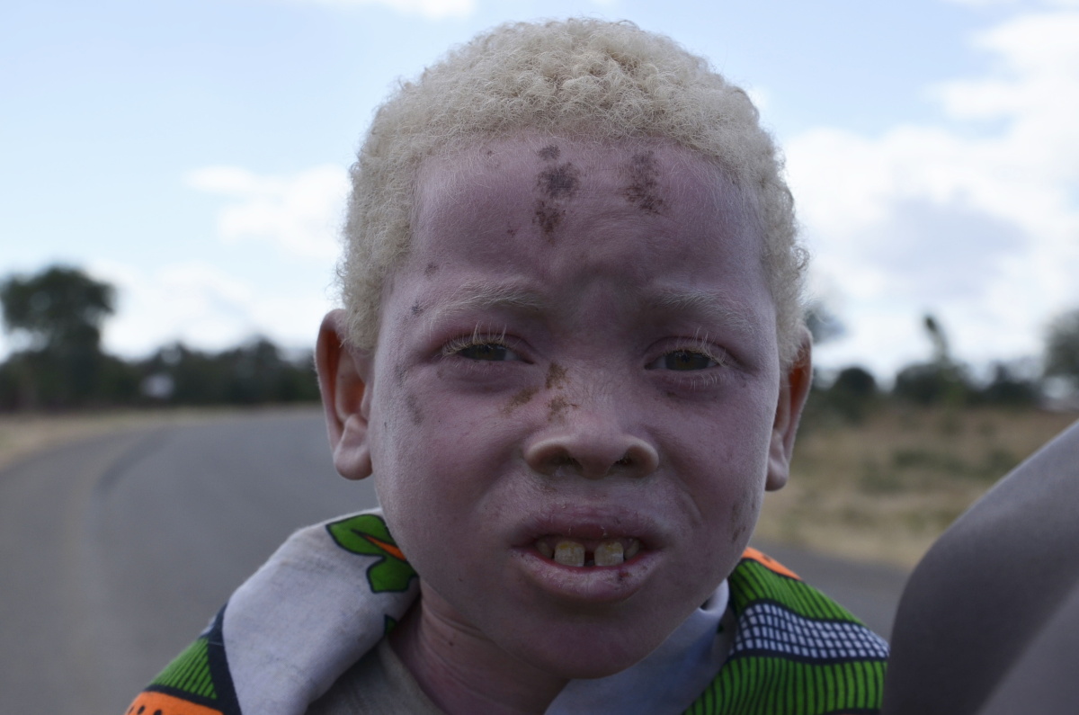 albín, albinizmus, Afrika