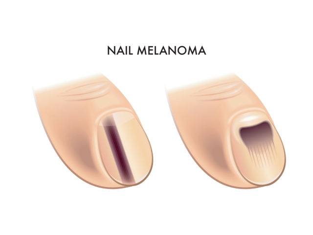 dva znaky melanomu pod nechtom, melanóm, necht, podnechtový melanóm