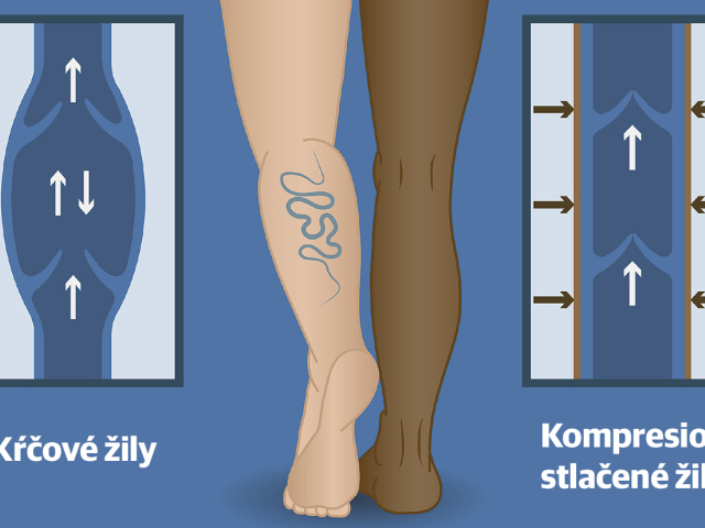 žily, kompresívna liečba, kŕčové žily