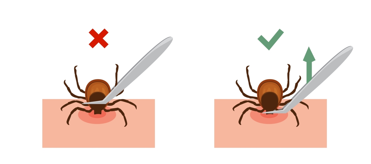 kliešť, vyberanie kliešťa, grafika, ako vybrať kliešťa