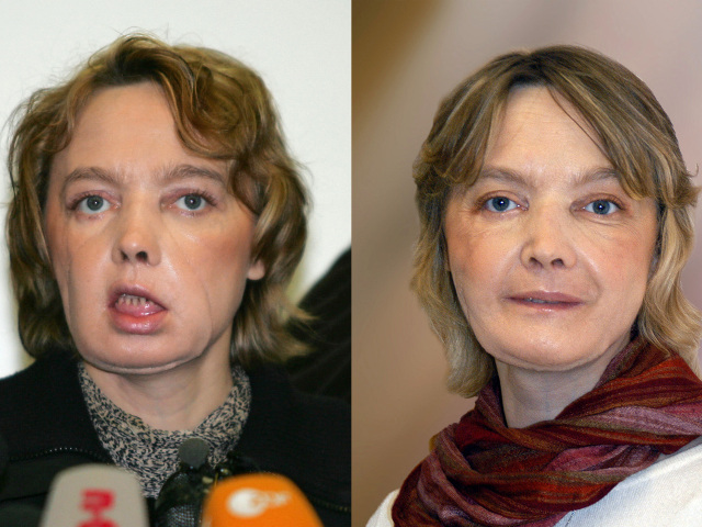 Isabelle Dinoire, transplantácia tváre